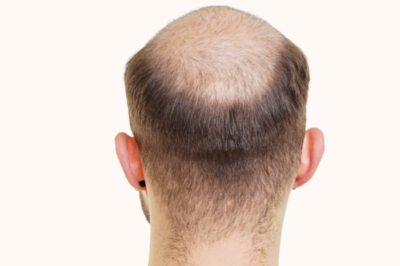 Hair Transplantation: A Permanent Solution to Hair Loss